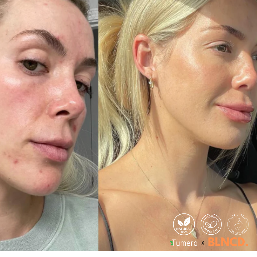 Tumera™️ Turmeric Foam Cleanser - Natural Cleanser - Remove Acne & Dark Spots