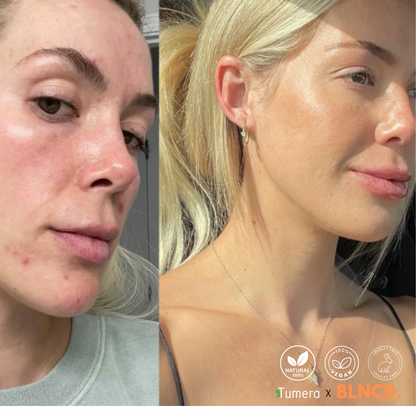Tumera™️ Turmeric Foam Cleanser - Natural Cleanser - Remove Acne & Dark Spots