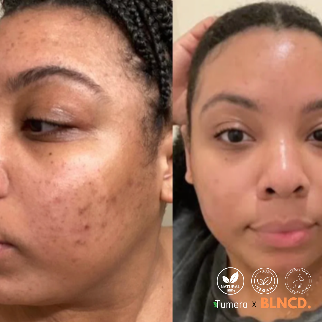 Tumera™️ Turmeric Foam Cleanser - Natural Cleanser - Remove Acne & Dark Spots