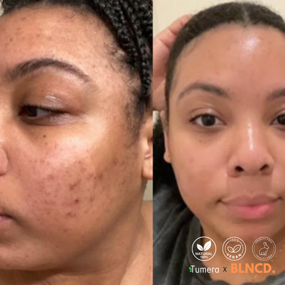 Tumera™️ Turmeric Foam Cleanser - Natural Cleanser - Remove Acne & Dark Spots
